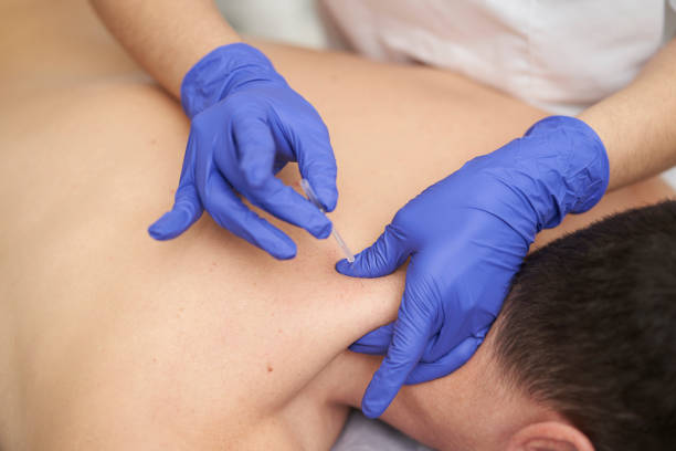 Four Amazing Benefits of Dry Needling: Know before You Start the Session